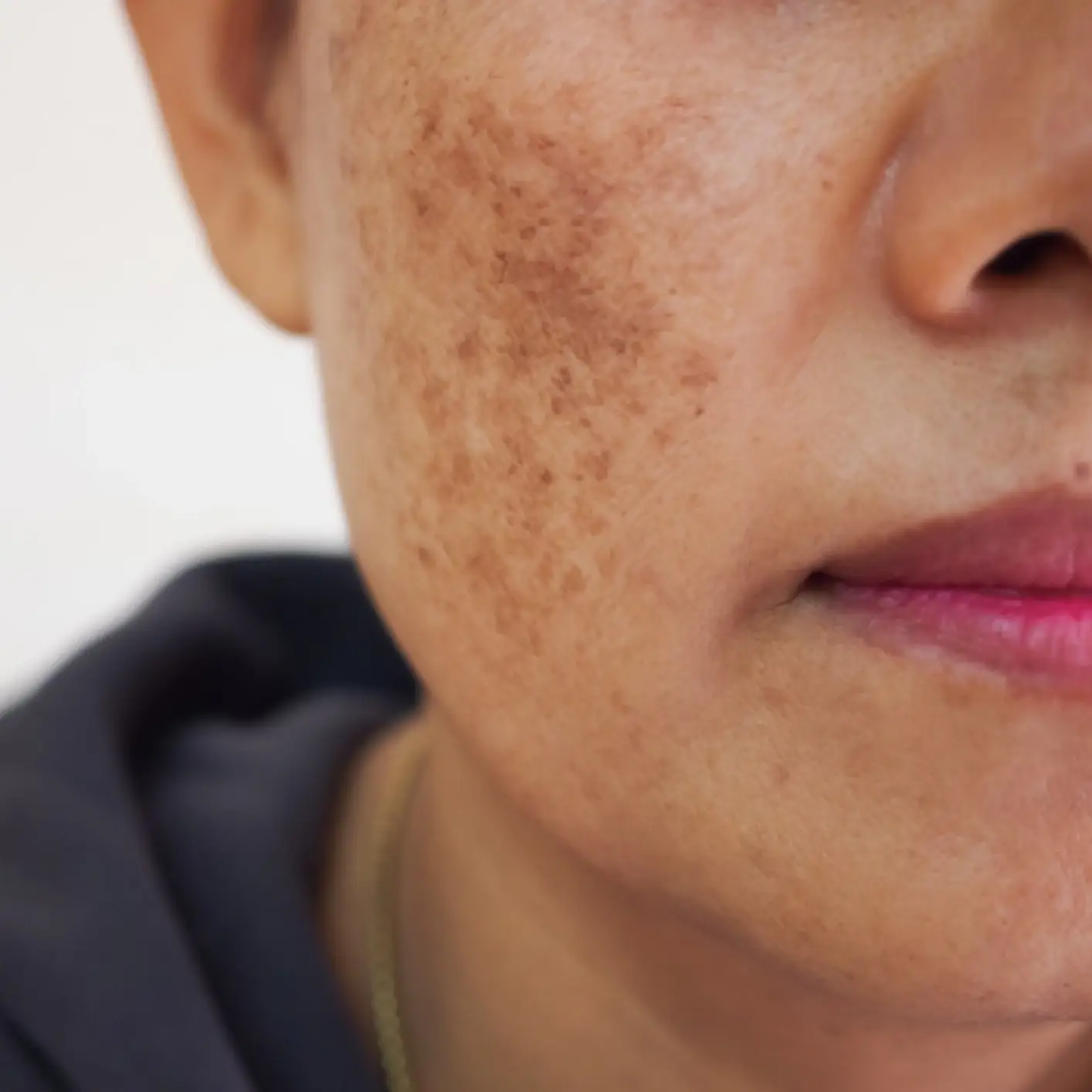 Pigmentation and sun damage treatment at Volt Cartel London