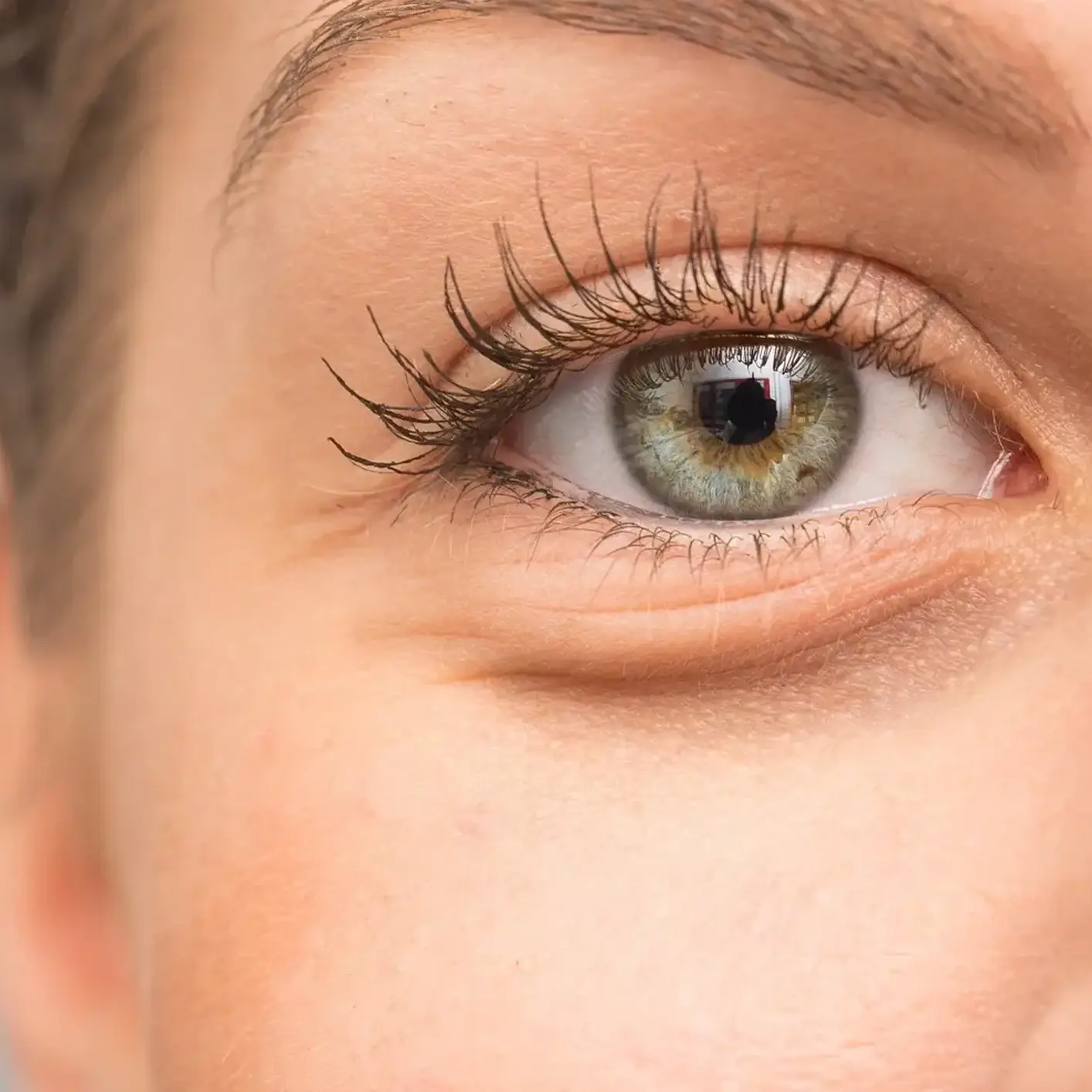 Under-eye bags and dark circles