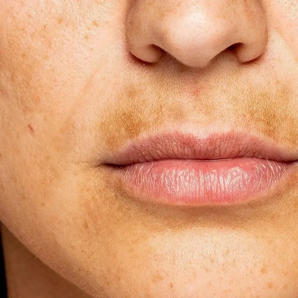 Uneven Skin Tone concern guide at Volt Cartel