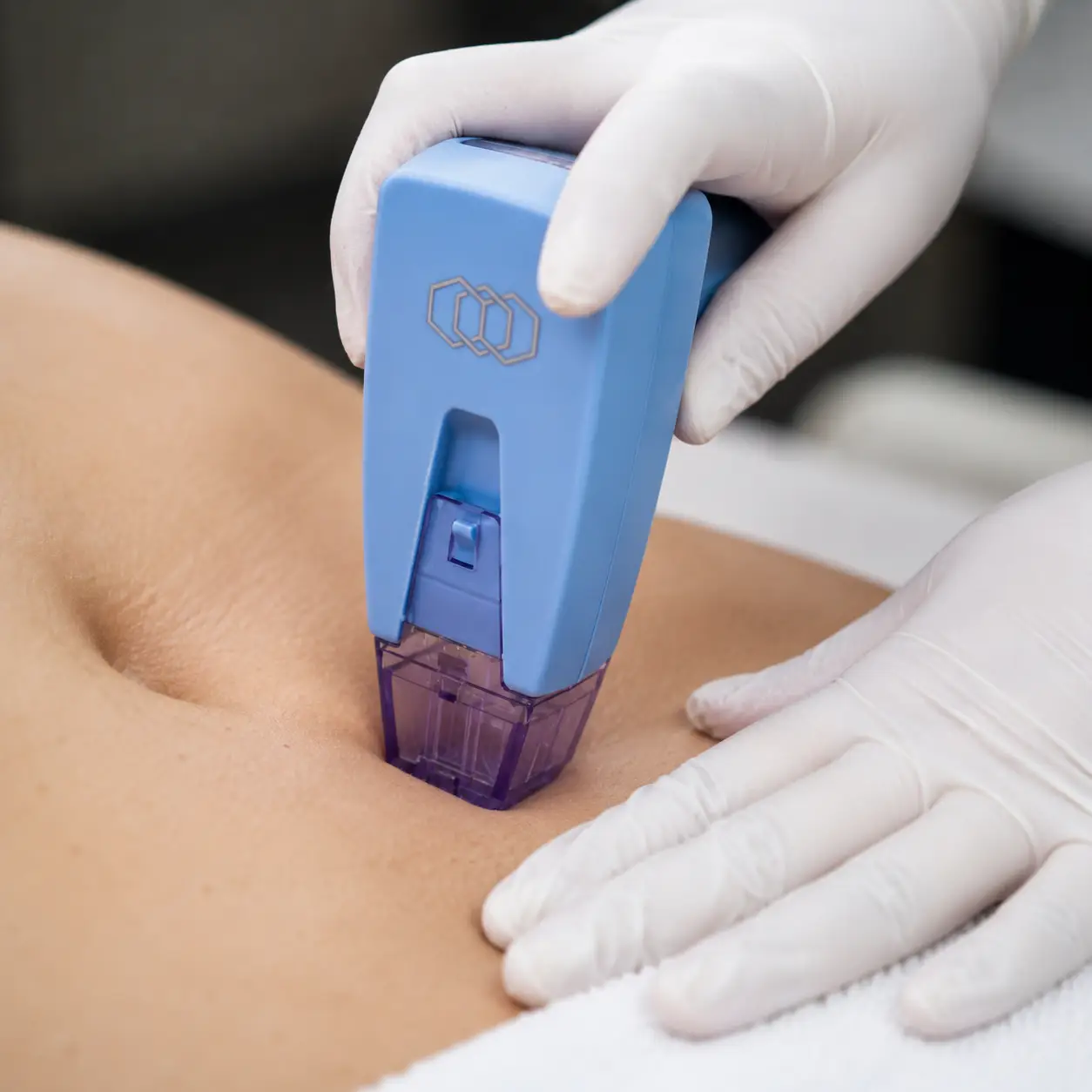 Morpheus8 body treatment — device applied to abdomen