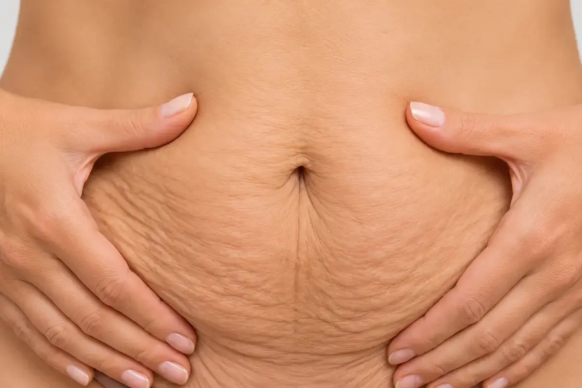 Body skin laxity — abdomen tightening with Morpheus8 Burst at Volt Cartel London